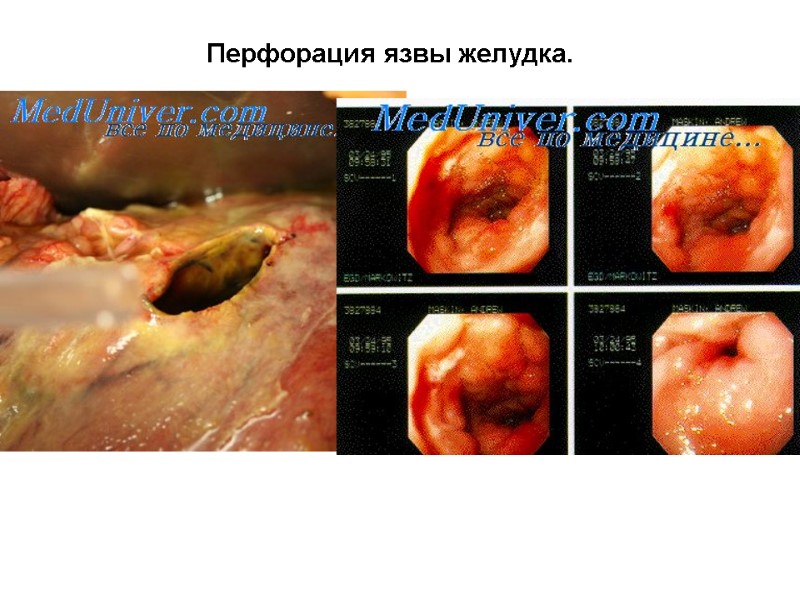 Перфорация язвы желудка.